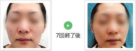 ケミカルピーリング事例